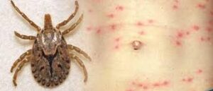 Scrub Typhus